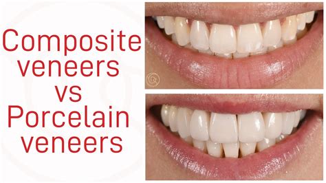 composite teeth veneers|cost of composite veneers.
